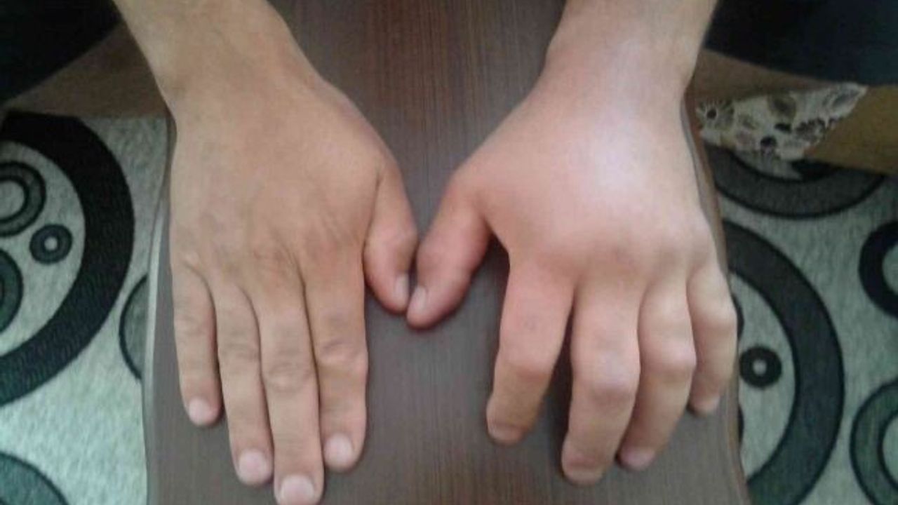 Türkiye’de tanınmayan hastalık: Alerji mi Herediter Anjiyoödem mi