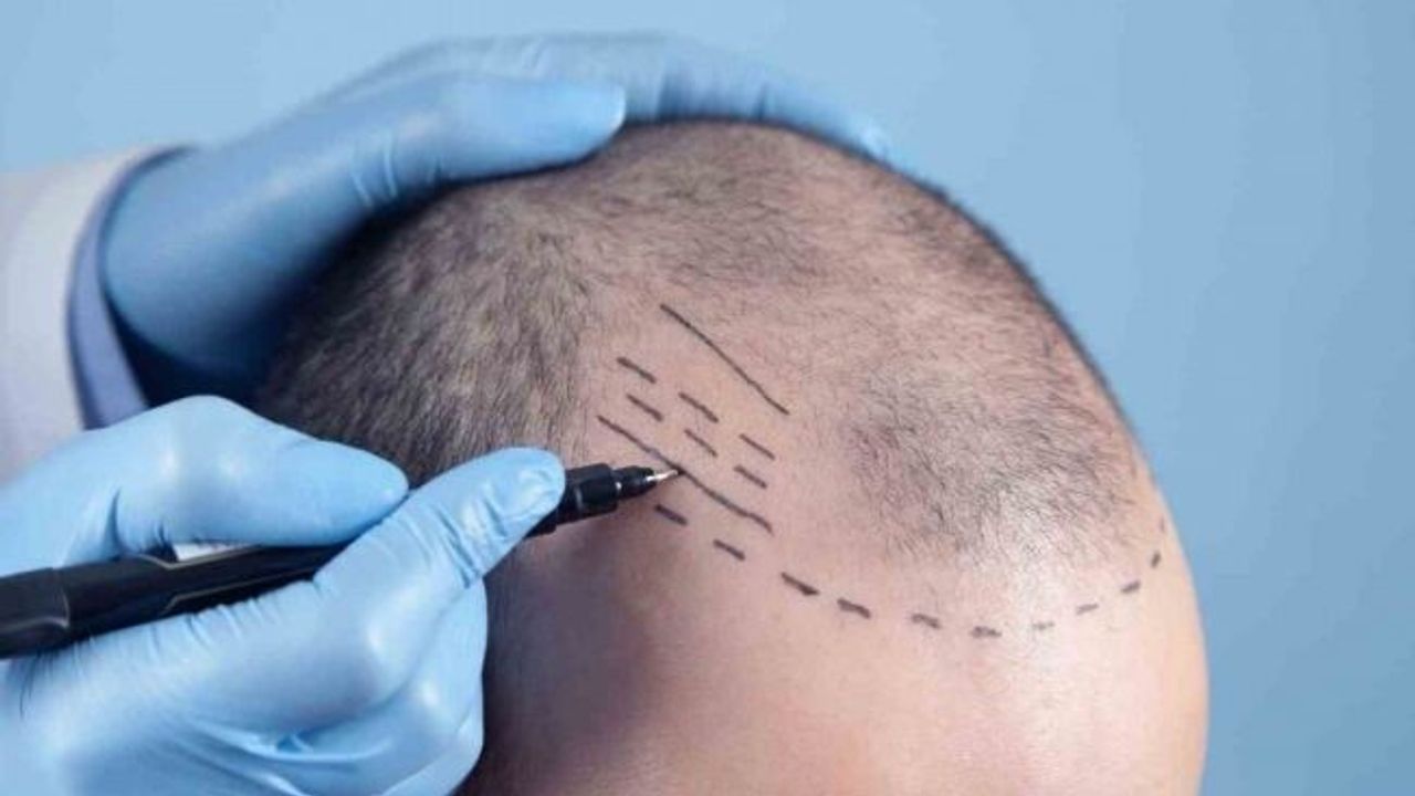 Dünyanın en iyi saç ekim merkezleri Türkiye’de