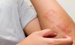 Bu iki kavramı karıştırmayın, besin alerjisi mi besin intoleransı mı