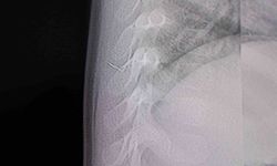 Bebeğin sırtından tel parçası çıktı