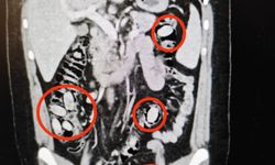 Midesinde taşıdığı uyuşturucu maddeler polisin dikkatinden sayesinde ele geçirildi