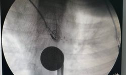 Siirt'te boğazına madeni para kaçan çocuk, doktorların müdahalesi ile kurtarıldı