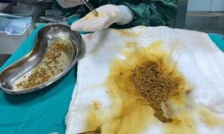 Bingöl'de nadir vaka: Safra kesesinden 2 bin 67 taş çıkarıldı