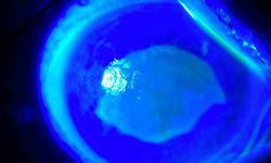 'Kırlangıç otu kullanımı'na dikkat, uzmanlar uyarıyor: 'Gözlerine suyunu damlattı, göremez hale geldi'