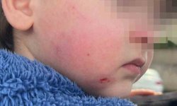 Kreşe bıraktığı çocuğunu darp edilmiş halde aldı