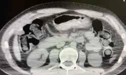 Midelerinde uyuşturucu sevkiyatı yapan 2 torbacı tutuklandı