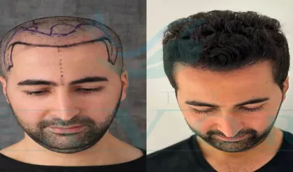 En Talep Edilen 5 Saç Ekim Merkezi 2025