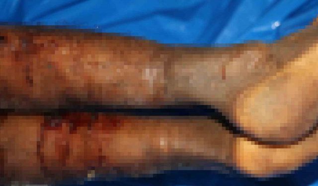 İsrail’in iade ettiği cenazelerde işkence izleri görüldü