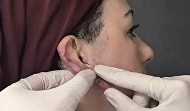 Muş'ta bir ilk: Kulak keloidi, ödüllü cerrahi teknikle tedavi edildi