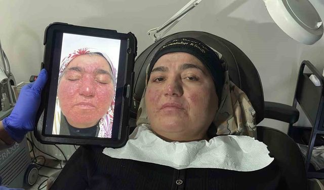 Hastalığı yüzünden yıllarca evden çıkamadı, şimdi ise çekinmeden çıkabiliyor