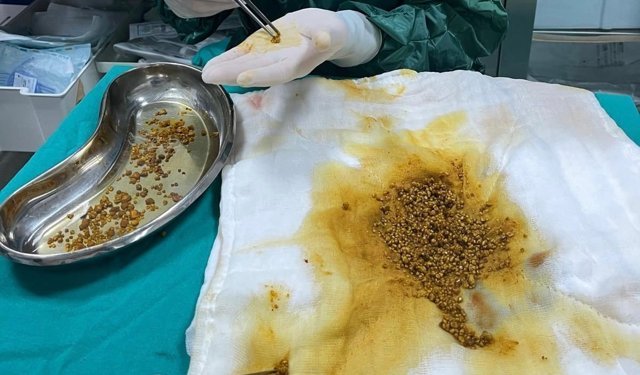 Bingöl'de nadir vaka: Safra kesesinden 2 bin 67 taş çıkarıldı