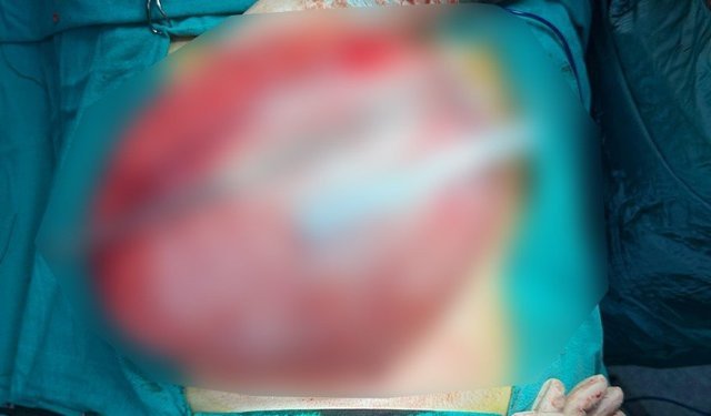 Kilo vermek için hastaneye giden çocuğun karnından 3,5 kiloluk kist çıktı