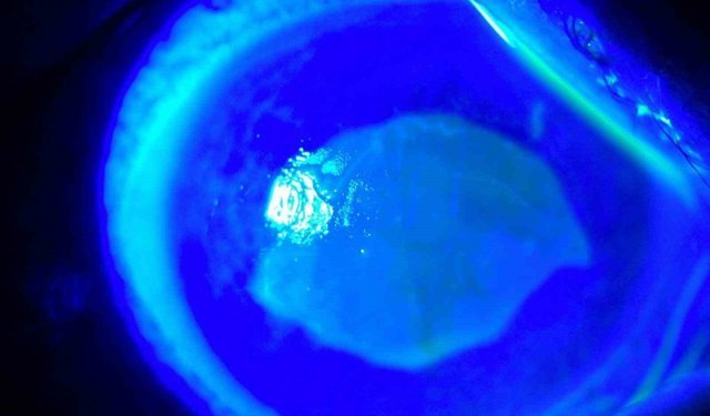 'Kırlangıç otu kullanımı'na dikkat, uzmanlar uyarıyor: 'Gözlerine suyunu damlattı, göremez hale geldi'