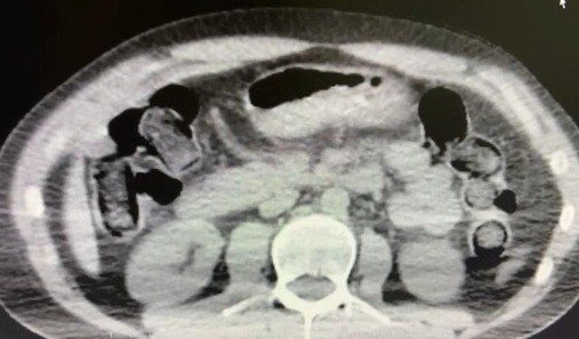 Midelerinde uyuşturucu sevkiyatı yapan 2 torbacı tutuklandı