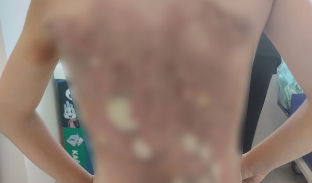 Arnavutköy'de akran zorbalığı iddiası: 12 yaşındaki çocuğun sırtını kolonya ile yaktılar