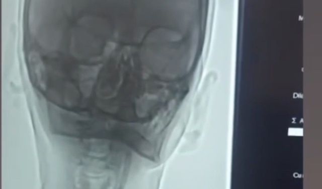 Iğdır'da şah damarı darlığına stentli müdahale