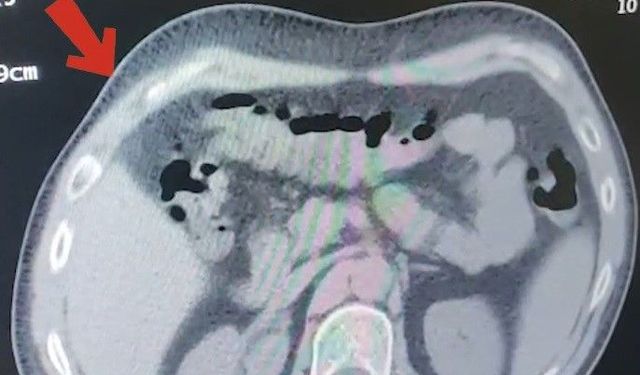 Mide ve bağırsaklarından 608 gram metamfetamin çıktı